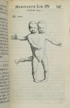 [Médecine] Nicolai Tulp - Observationes Medicae - 1739 - figures - Photo 3, livre ancien du XVIIIe siècle