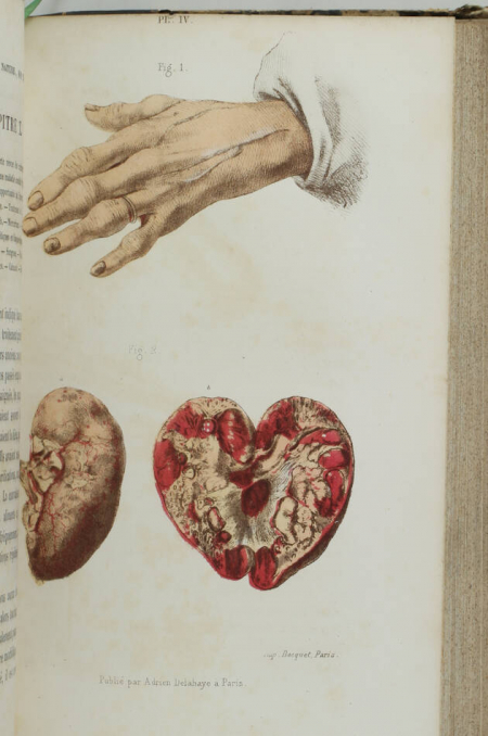 BARING GARROD (Alfred) [et CHARCOT (J. M., notes de)]. La goutte, sa nature, son traitement et le rhumatisme goutteux, livre rare du XIXe siècle