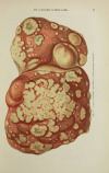 HANOT et GILBERT - Etudes sur les maladies du foie - 1888 - Figures en couleurs - Photo 0, livre rare du XIXe siècle